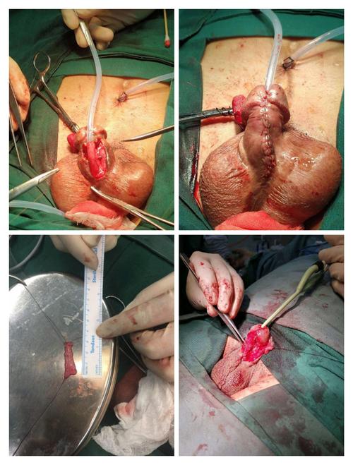 目前开展的男性尿道诊疗技术主要包括:经尿道尿道狭窄激光/冷刀切开术