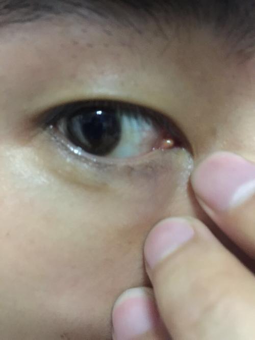 这是泪腺肿大吗 有很多年了,这眼比那只眼视力要差