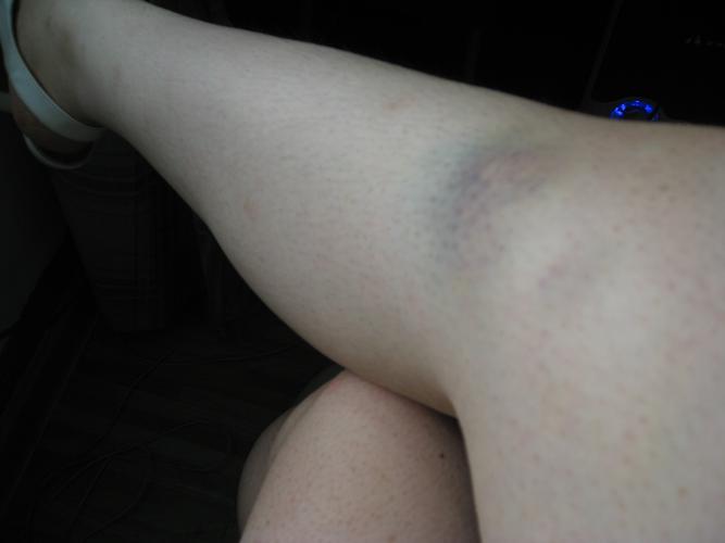 腿上这两天莫名出现淤紫