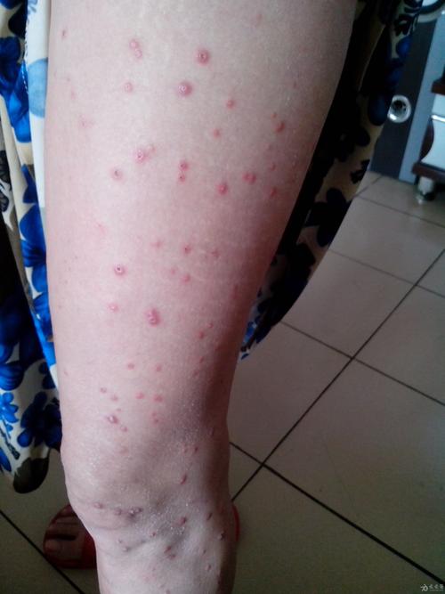 皮肤病 糖尿病10年余,血糖控制餐后10左右