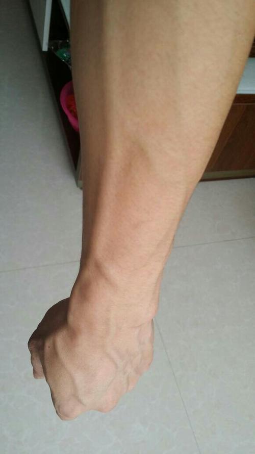 手伸直垂下手背上的血管就异常凸起 请问这是什么问题