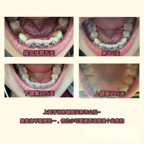 牙齿情况:拥挤,前凸