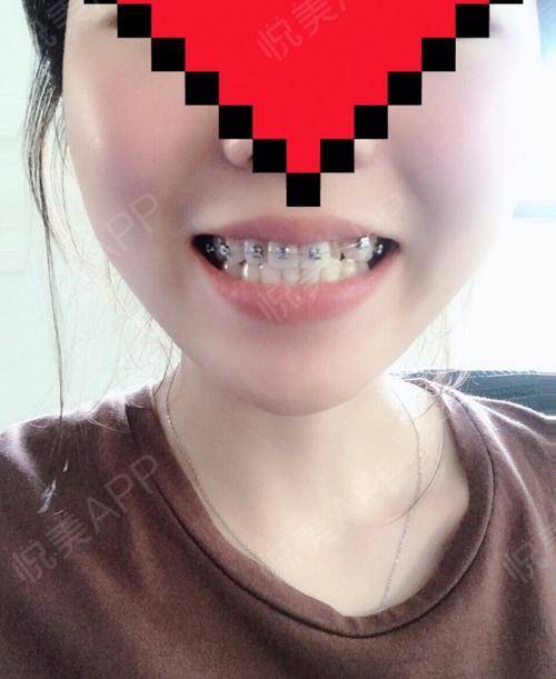自锁托槽矫正手术当天_金属托槽矫正手术当天_牙齿矫正手术当天_牙齿