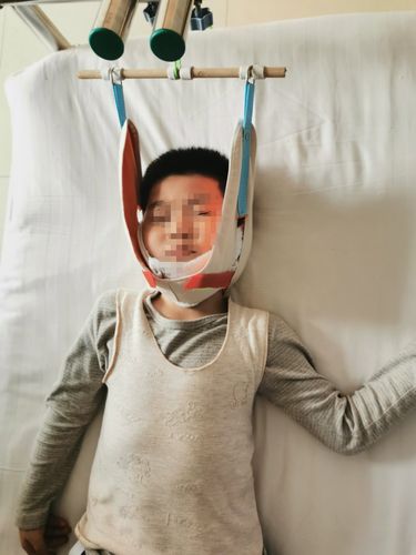 小儿寰枢椎半脱位,你了解吗?