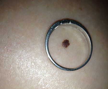 胸口有颗黑痣,但是看着像颗黑色肉瘤.直径大约2mm.