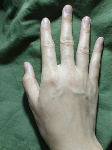 手被钢笔戳了留下黑点?