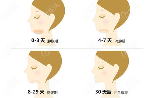 了解下颌缘吸脂优缺点后再看下双下巴吸脂的恢复效果图好不好吧