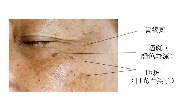 晒斑,肝斑,黄褐斑,你能分清吗?