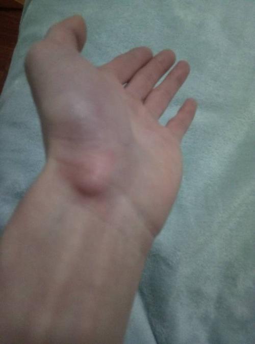 手腕处长了一个包,有两年了,不痛不痒,不知道是怎么回事儿?