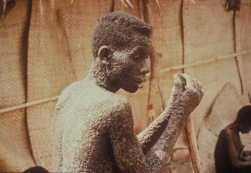 迹象出现在3000年前印度和埃及,甚至一些埃及木乃伊里发现了天花病毒