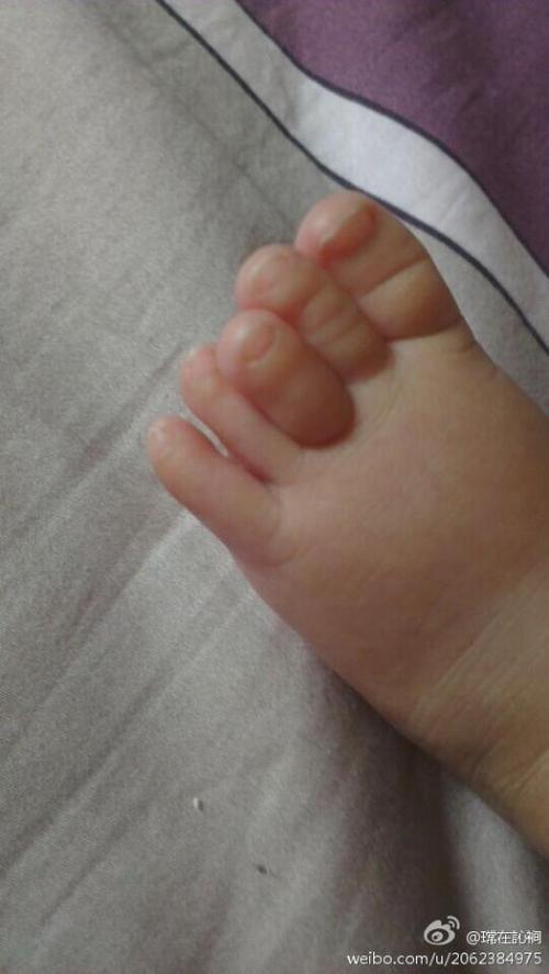 对说:崔医生,我家宝宝两只脚的中指都有上翘,对以后有