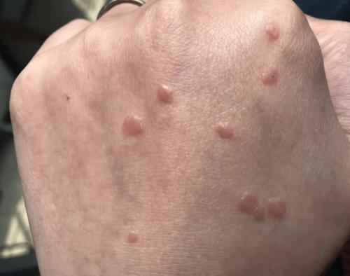 杨雪最近发现自己手指头上长出来一些像针头一般的扁平小丘疹,而且