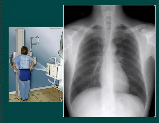 胸片入门攻略,看完不信你还学不会!