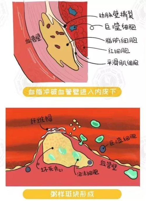 动脉硬化斑块血管里的致命堵塞物