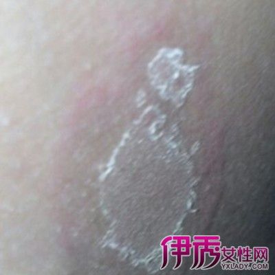 【图】睾丸脱皮怎么办 其疾病危害介绍