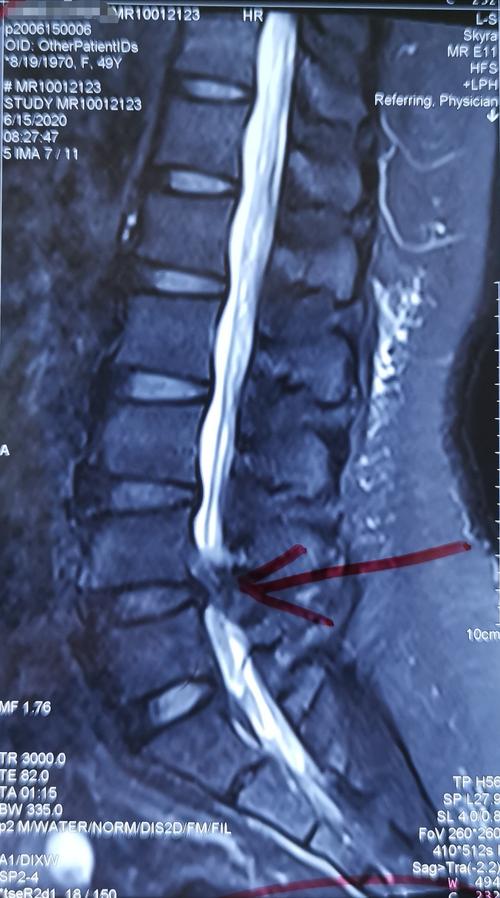 51岁腰椎间盘突出,黄韧带肥厚,椎管狭窄患者手术一例