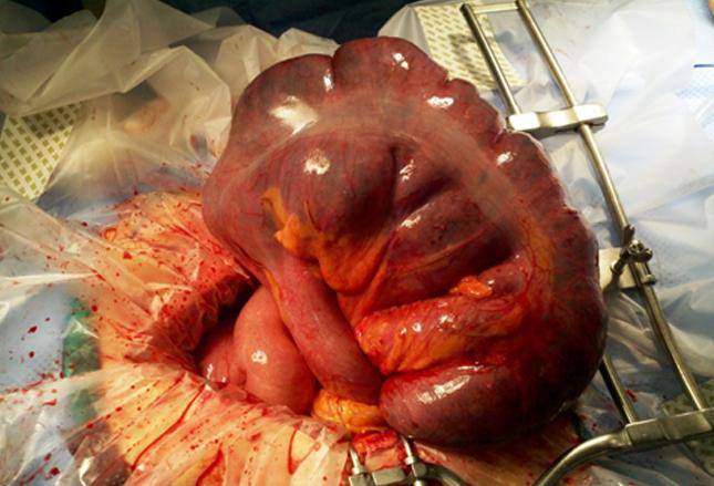 肠梗阻怎么办 正确治疗肠梗阻的办法