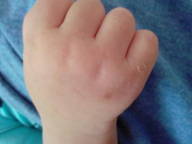 我宝宝这里之前也是这样,蚊子咬的,宝宝皮肤嫩,被蚊子咬了,一个星期了