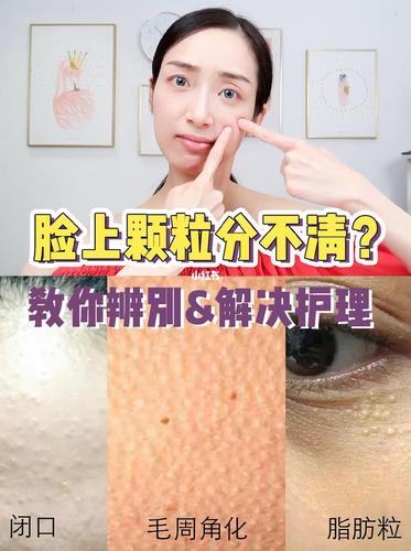 闭口,毛周角化,脂肪粒|如何正确区分95_脂肪粒_闭口