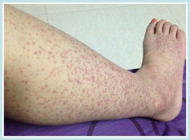 过敏性紫癜可发展为肾炎