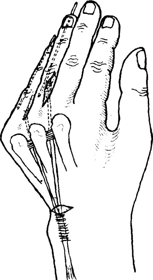 可固定在环,小指的伸肌腱斜形纤维上(图6-14-8),或屈肌腱鞘滑车上(图6