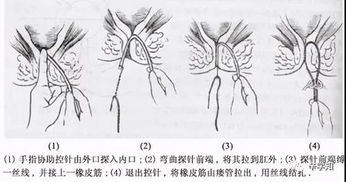 得了肛瘘为什么不能自愈