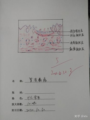 胃溃疡 红蓝铅笔手绘
