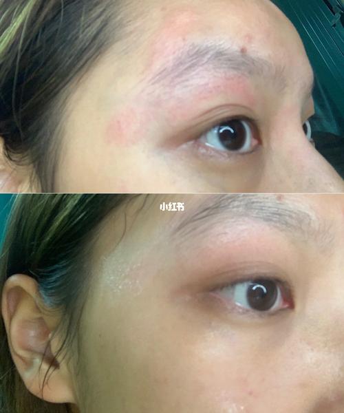 皮炎_过敏性皮炎_医疗健康_医疗健康其他