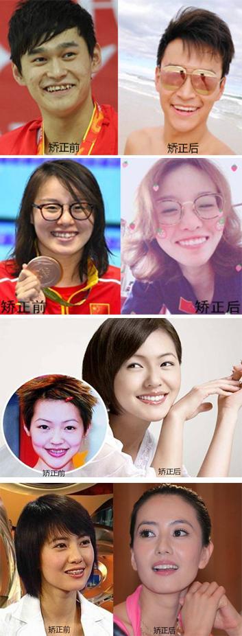 牙齿矫正前后对比照