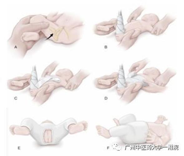 (注:部分临床医师绑石膏时会选择蛙位固定,通过临床观察方教授认为