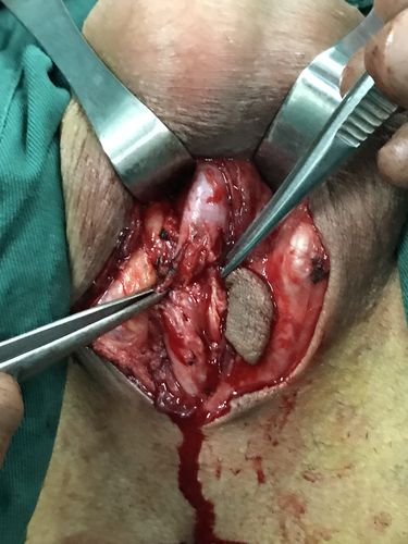 orandi皮瓣尿道成形术