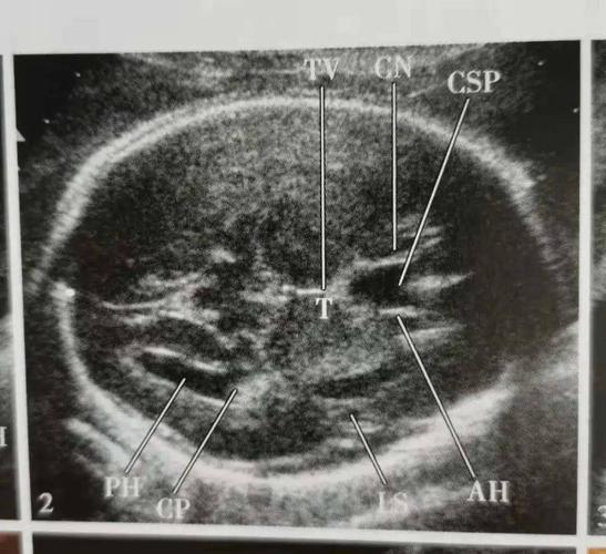 【新手必看】中孕期胎儿超声检查 — 颅脑和颜面部分