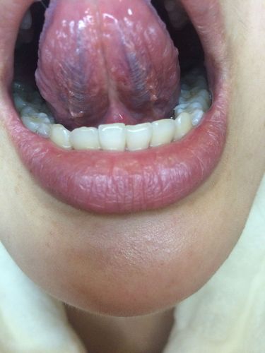 去医院做健康检查,早期尖锐湿疣.后来发现口腔这样的