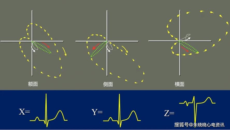 一文掌握心电向量:从基本原理到临床应用