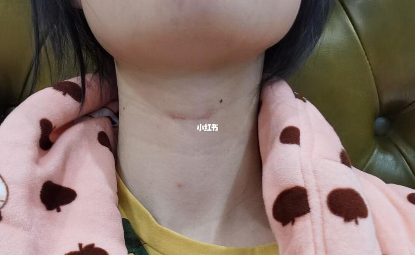 舌甲囊肿切除大半年后疤痕恢复情况_疤痕_夏天去哪玩