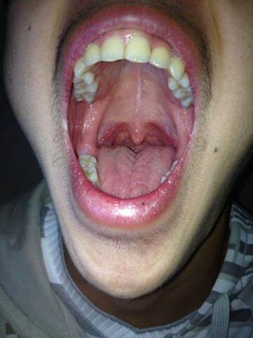 正常人的扁桃体图片