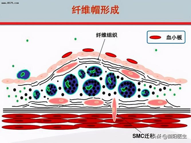 脂质斑块外层有一层纤维帽包裹,纤维帽有的厚,有的薄.
