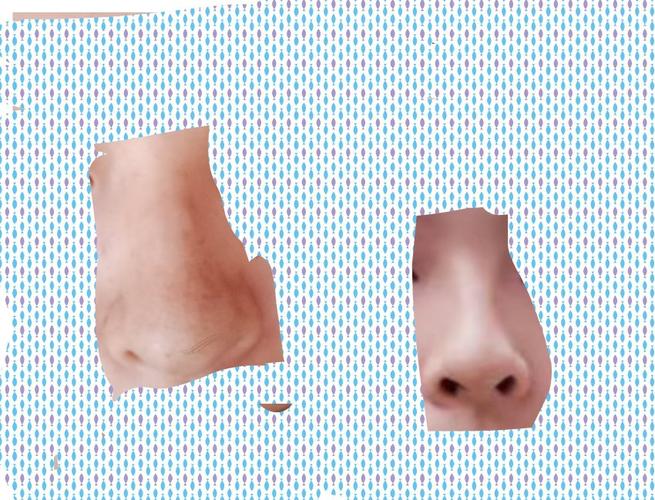 鼻中隔偏曲手术后鼻子塌了,如图,怎么办想找医院理赔