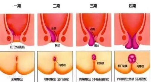 昨天切痔疮今天就吃火锅这是什么神操作