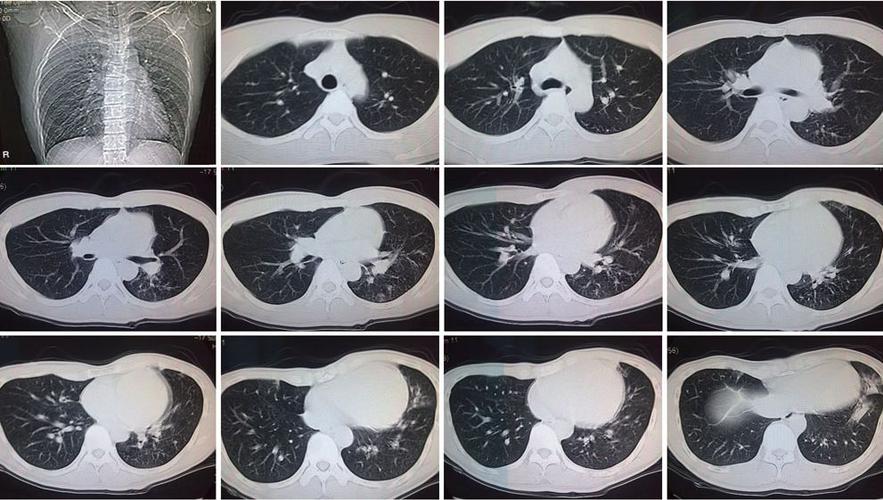 片可能影像学不太明显, 特别是对于无症状患者,可在肺部ct上出现特征