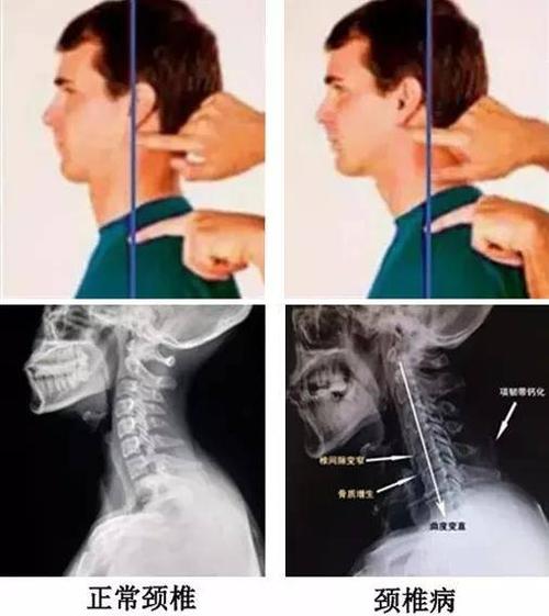 你的颈椎它早已偷偷变形了!