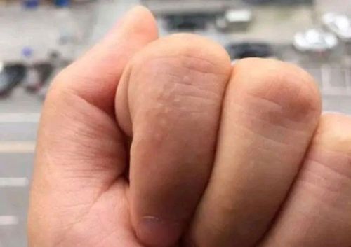 手上有透明的小水泡或许不是上火导致的