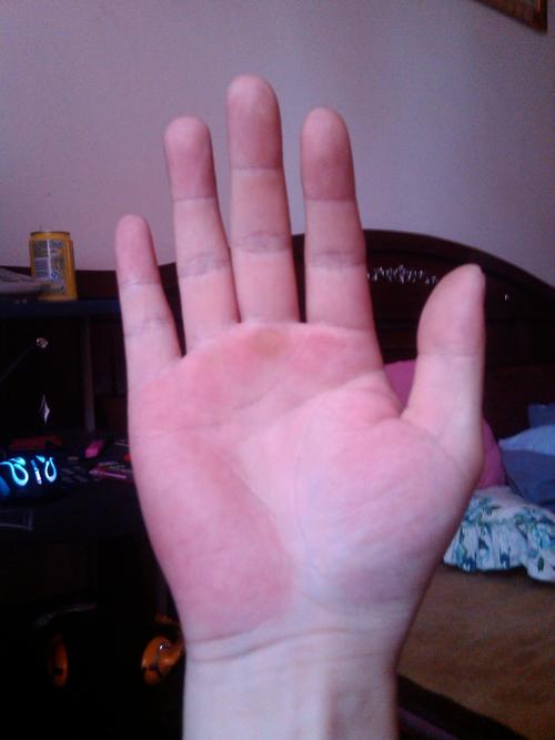 手掌发红 是肝掌吗