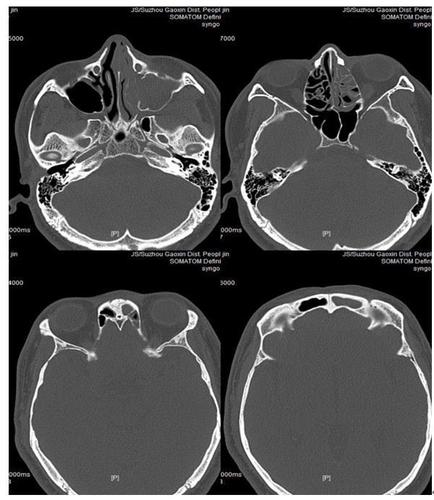 第二步:鼻部ct片平扫