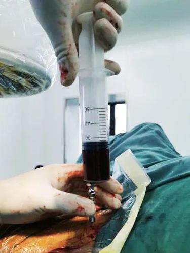 【新技术】"微创 骨髓血移植"——南昌市第九医院骨科