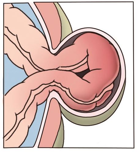 肠梗阻有哪些临床表现