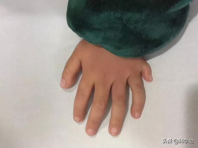 狐猴和大熊猫都是六指,如果人类也多一根手指会怎样?