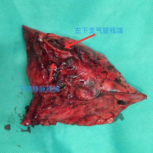 胸外科顺利完成胸腔镜微创肺隔离症手术