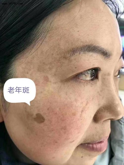 面部的各种色斑如何辨别