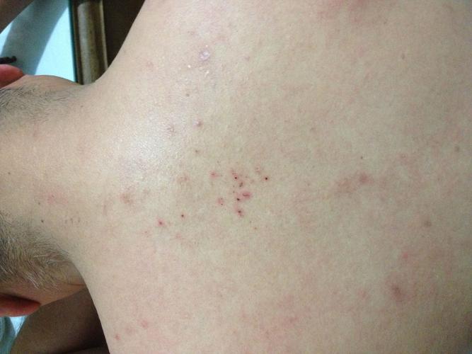 后背和手臂上长了好多红疹,很痒,已经持续一个月.